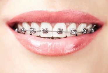 Non Extraction Orthodontics