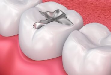 Dental Fillings