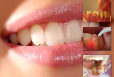 Gum Treatments