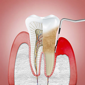 Periodontal Disease
