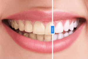 How Long Does Professional Teeth Bleaching Last?
