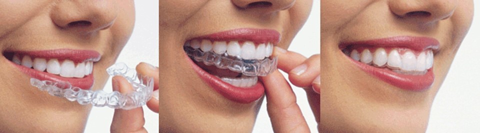 Invisalign Langmore Dental | Berwick Dentist