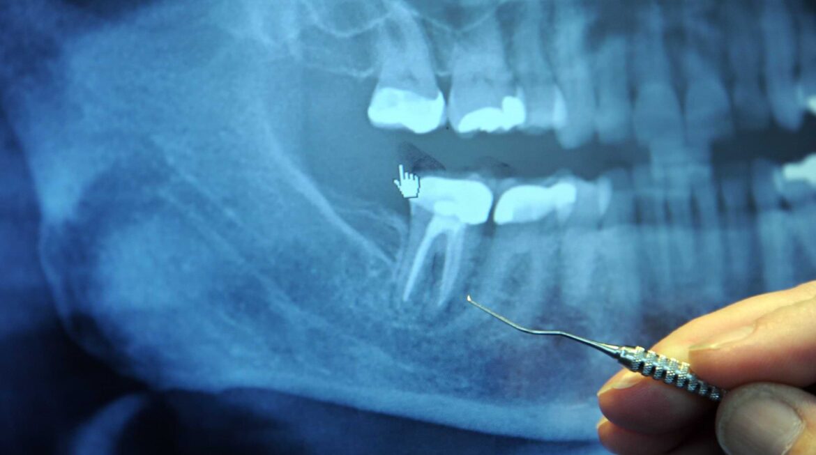 What Is The Difference Between Root Canal Treatment and Tooth Extraction?