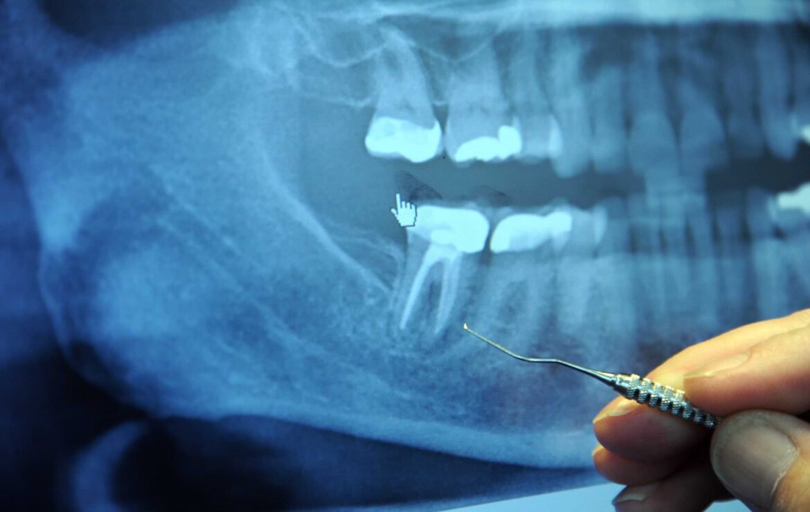 What Is The Difference Between Root Canal Treatment and Tooth Extraction?