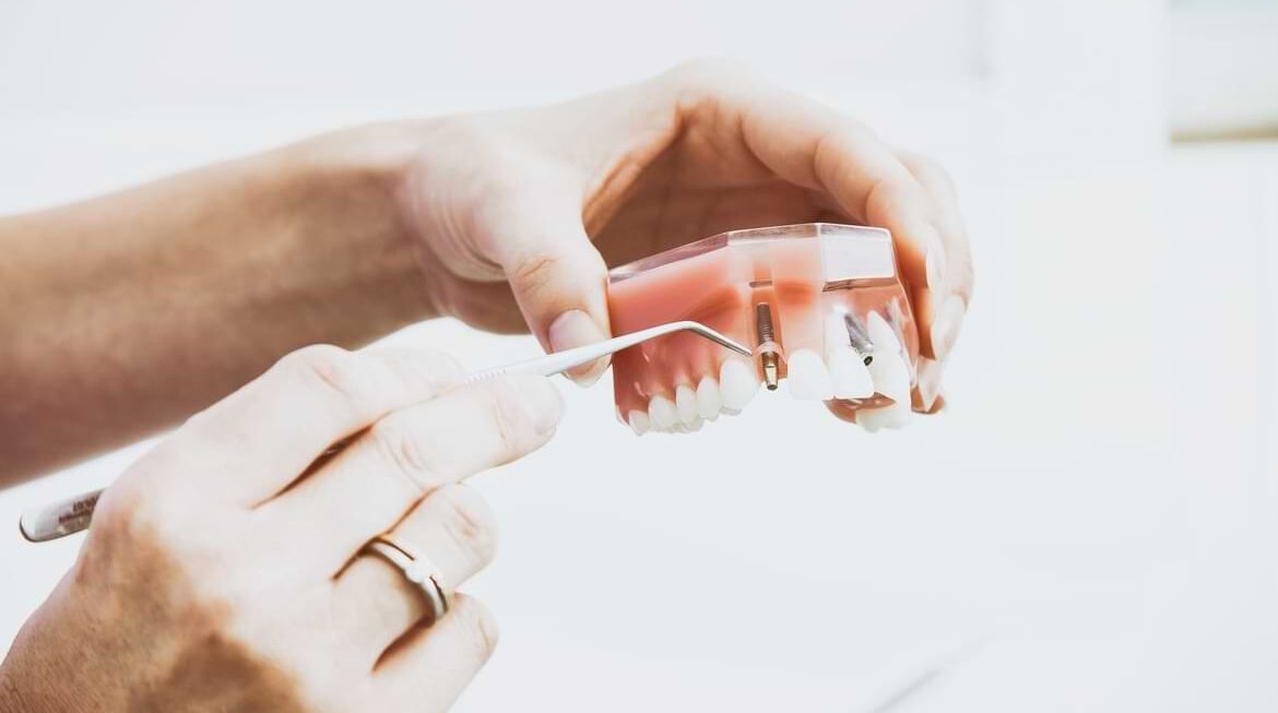 What Are the Advantages of All-On-4 Dental Implants?