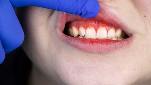 What Is Gingivitis & What Can You Do?