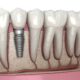 “How Do Dental Implants Work?” & All Your Other Important Dental Implant Questions Answered