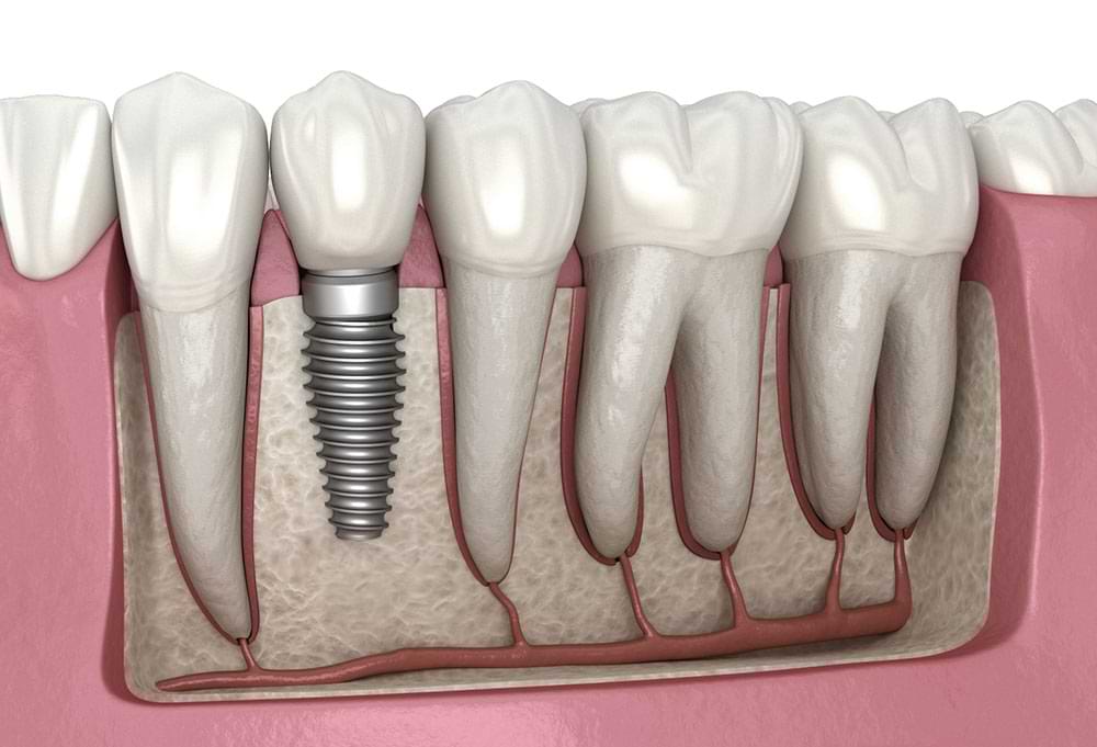 “How Do Dental Implants Work?” & All Your Other Important Dental Implant Questions Answered
